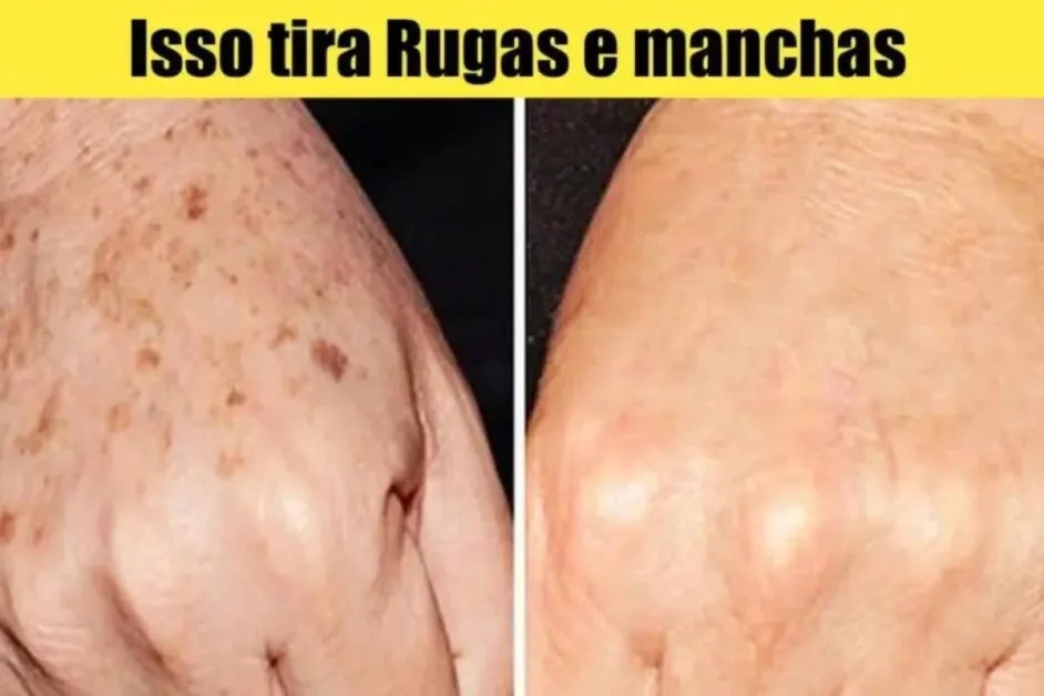 Formas Naturais para Eliminar Manchas nas Mãos Rápido Receitas Eficazes e Dicas