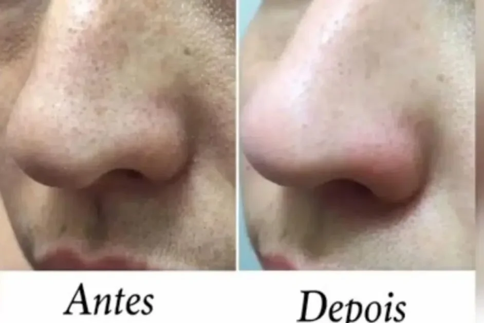 Limpeza de Pele Caseira, Veja Como Remover Cravos e Espinhas