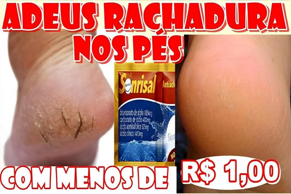 Como acabar com as rachaduras dos pés com uma misturinha caseira muito fácil de fazer